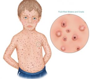 chickenpox-1