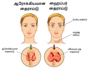 hyper-thyroid-remedies-19-1455860361